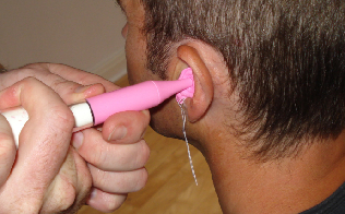 Ear Mould Impression